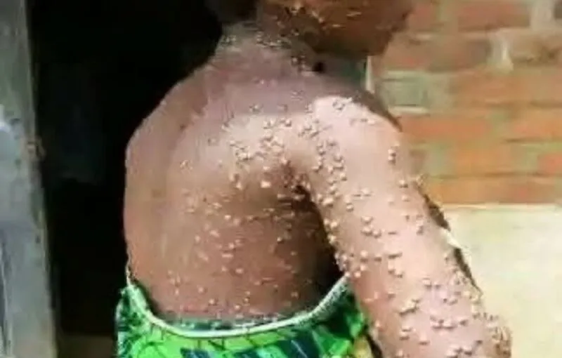 Huambo confirma primeiro caso de Mpox em mulher de 24 anos e reforça vigilância epidemiológica