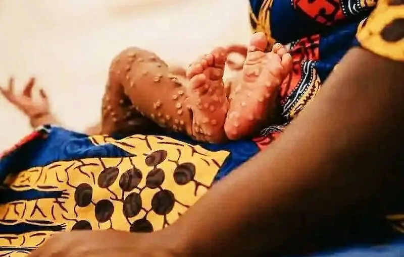 Angola regista 19 novos casos de mpox e sobe para 107 casos activos; total acumulado chega a 615 segundo o Novo Jornal