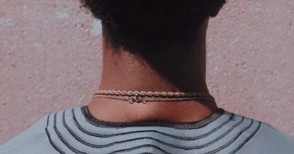 Jovem de 23 anos perde todo o cabelo após crise de stress no trabalho e é diagnosticada com alopecia areata