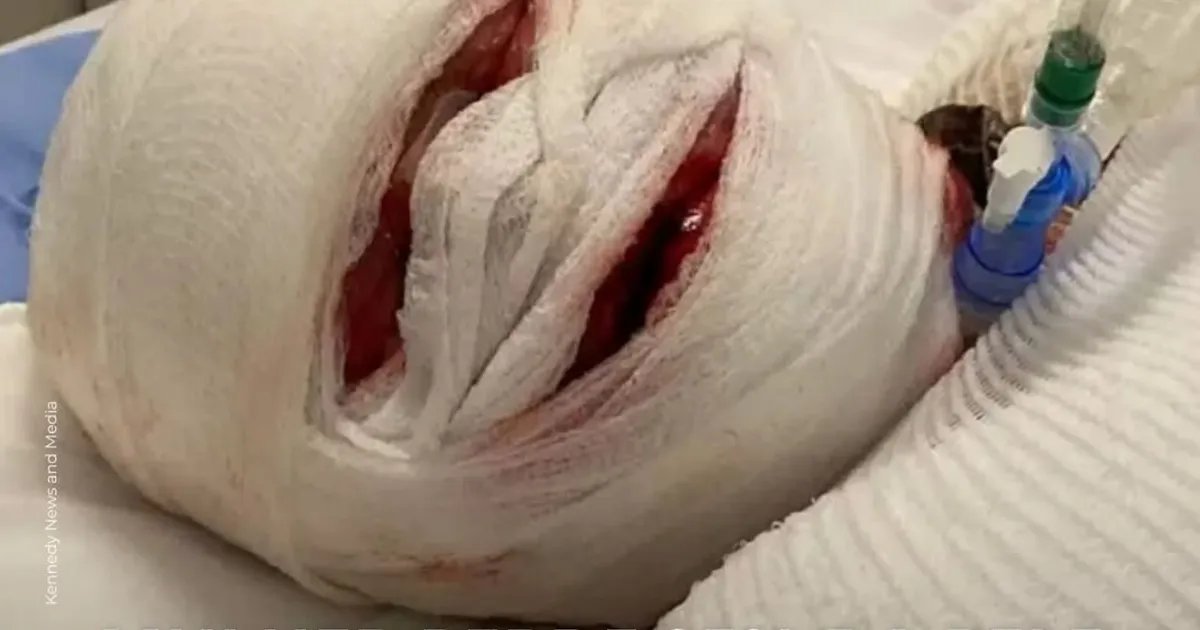 Mulher perde 95% da pele por tomar ibuprofeno após cesariana