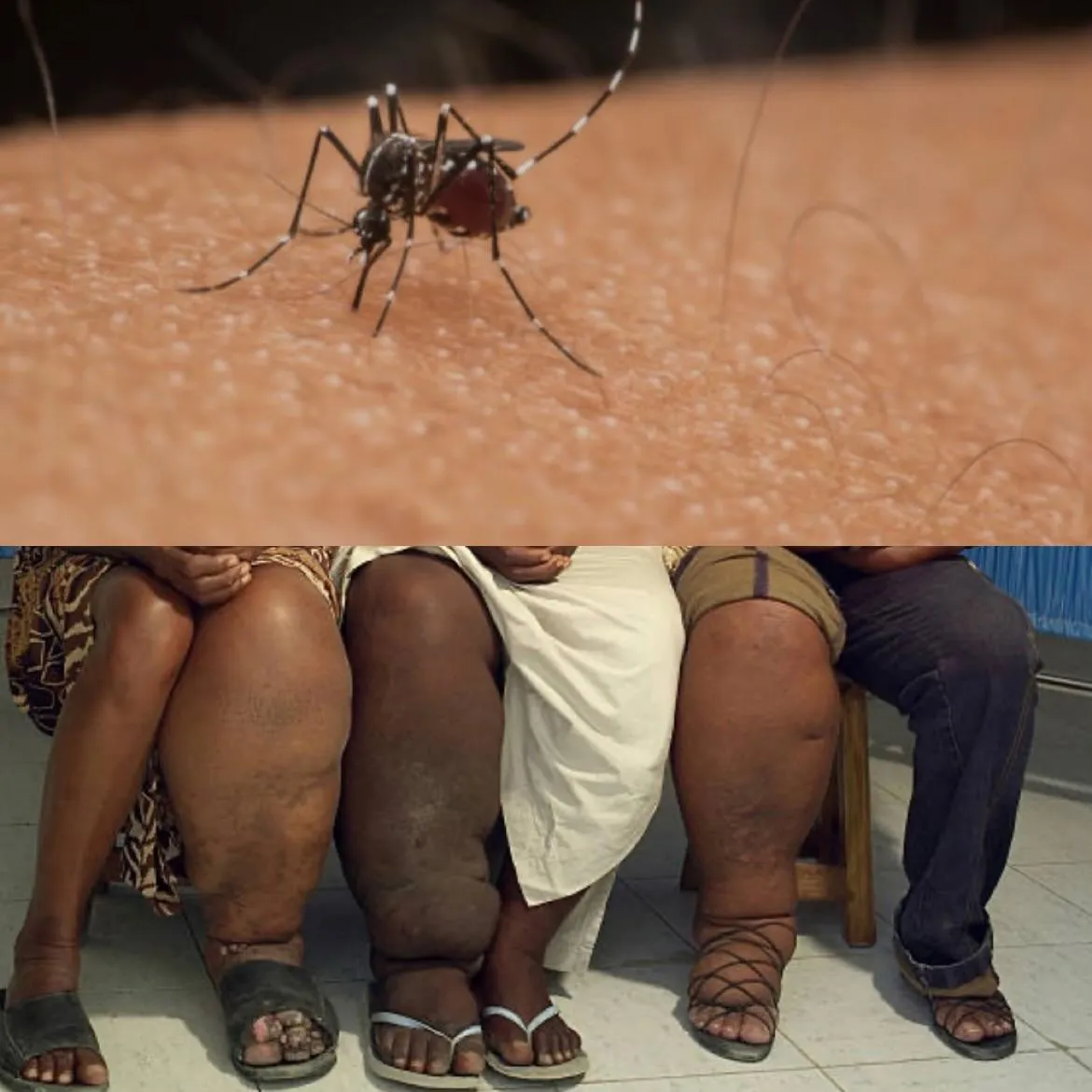 Elefantíase: saiba como identificar, tratar e prevenir a doença que tem crescido em Angola
