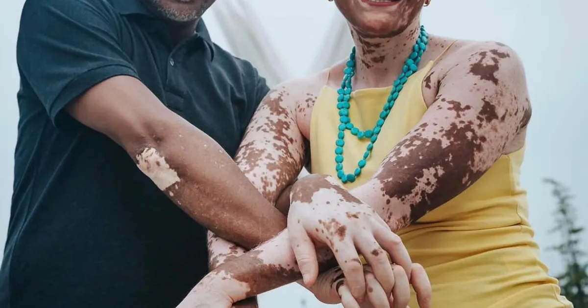 Conscientização do Vitiligo: data reforça a luta contra o preconceito e a desinformação