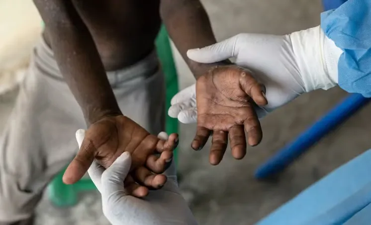 Luena confirma circulação comunitária de MPOX com 10 casos registados