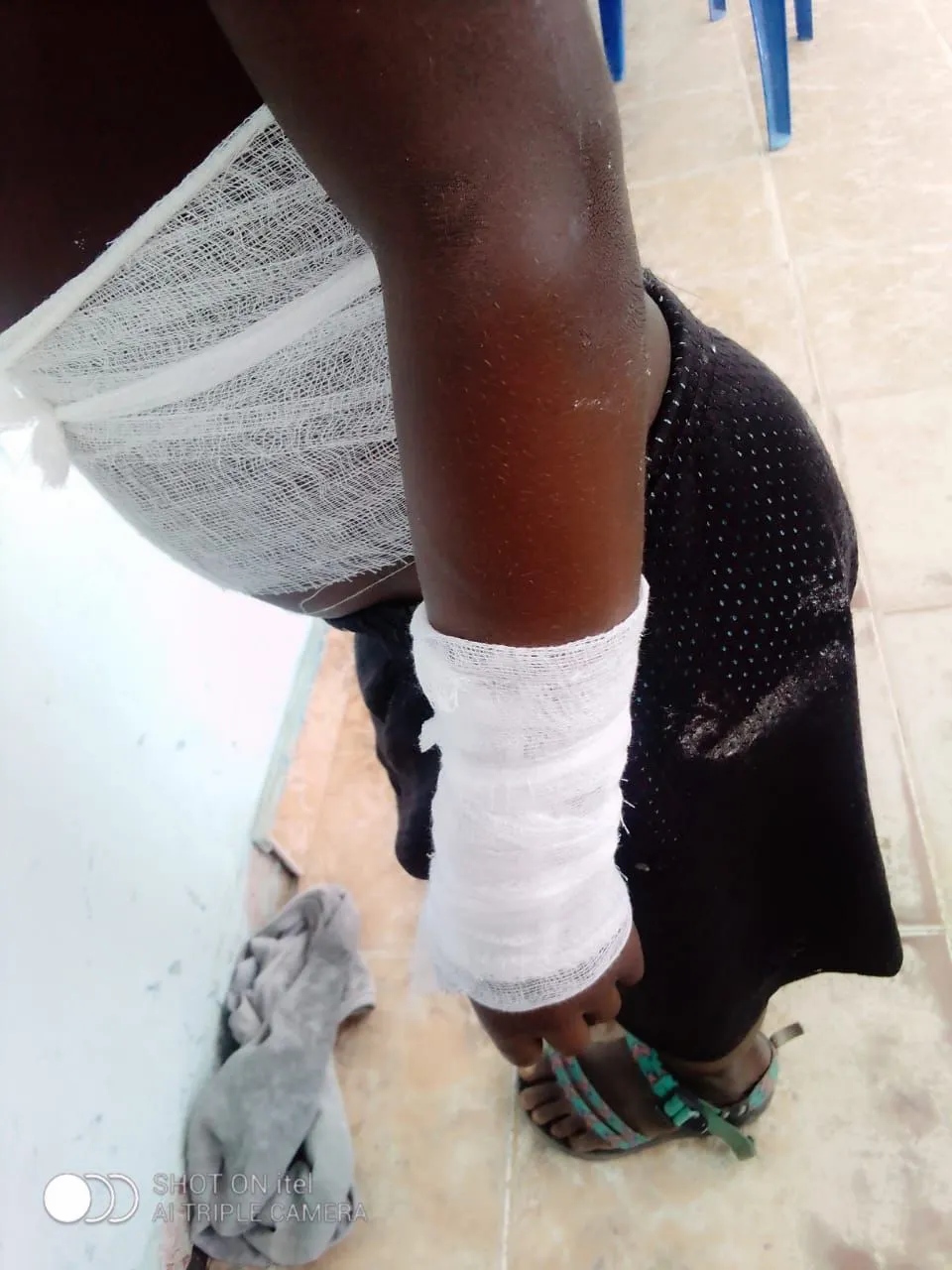 Criança de 9 anos queimada por pisar no relvado no município da Camama