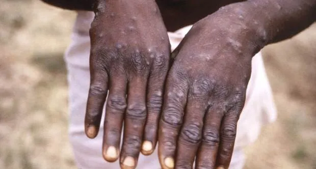 Cabinda regista 24 novos casos suspeitos e prepara nova campanha de vacinação contra Mpox