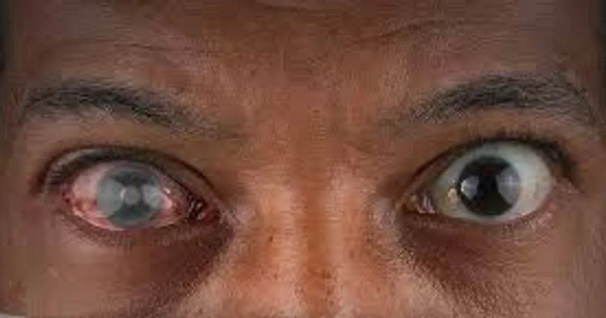 Assinala-se hoje dia 26 de Maio, o Dia Nacional de Combate ao Glaucoma