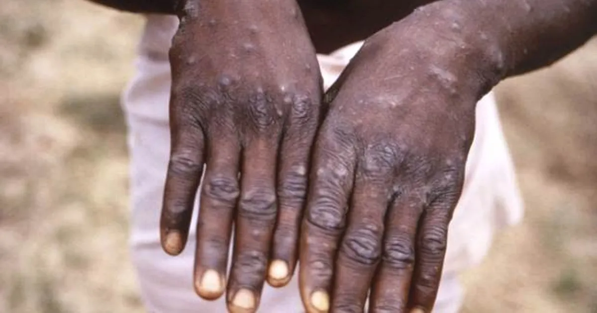 Confirmados primeiros casos de mpox em Moçambique