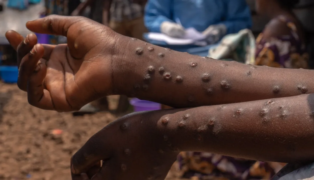 Cabinda soma 109 casos de Mpox