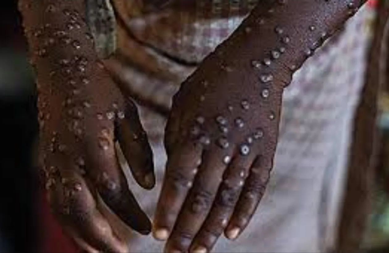 Três membros da mesma família testam positivo para Mpox no Panguila