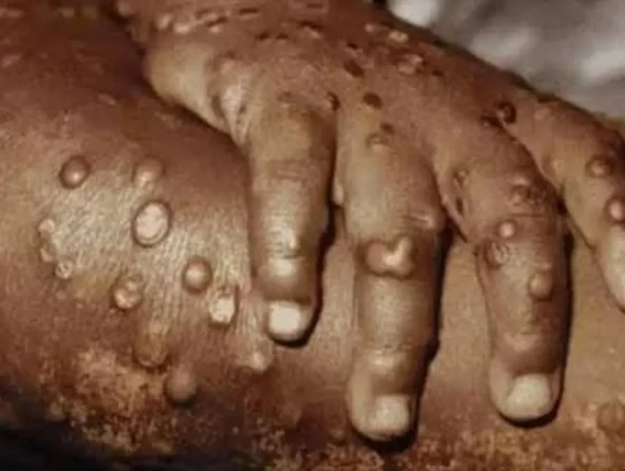 Mpox causa primeira morte confirmada em Cabinda