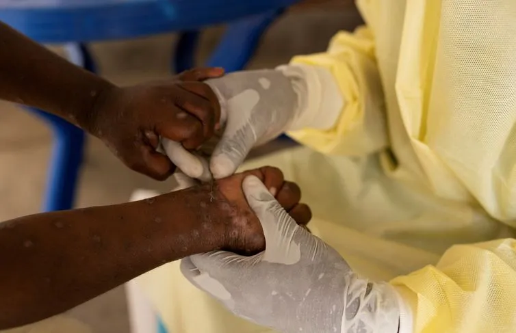 Cuanza-Sul confirma dois primeiros casos de mpox nos municípios do Sumbe e do Wako-Kungo