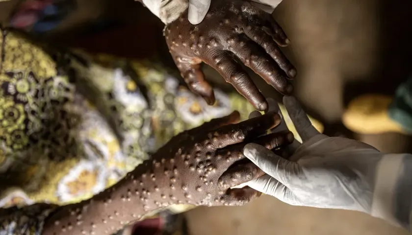 MAIS 109 CASOS CONFIRMADOS DE MPOX EM CABINDA