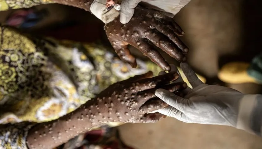 Cabinda Com Cinco Casos Positivos De Mpox Em 20 Suspeitos