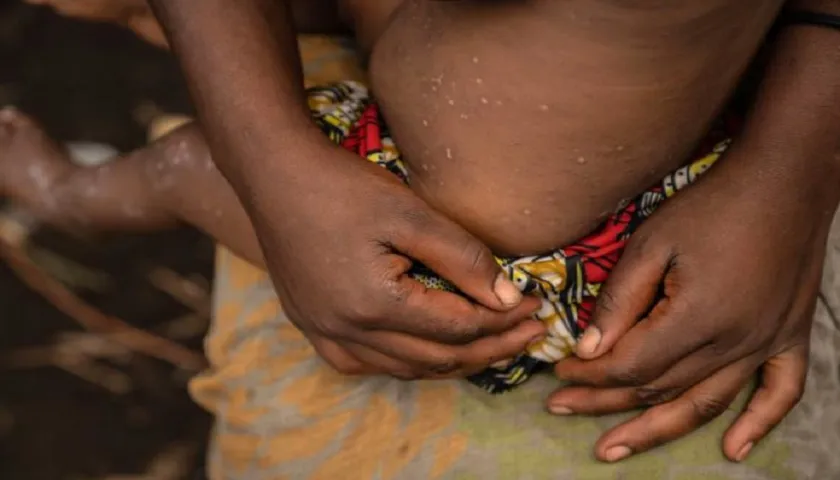 GOVERNO RECONHECE SURTO DE MPOX