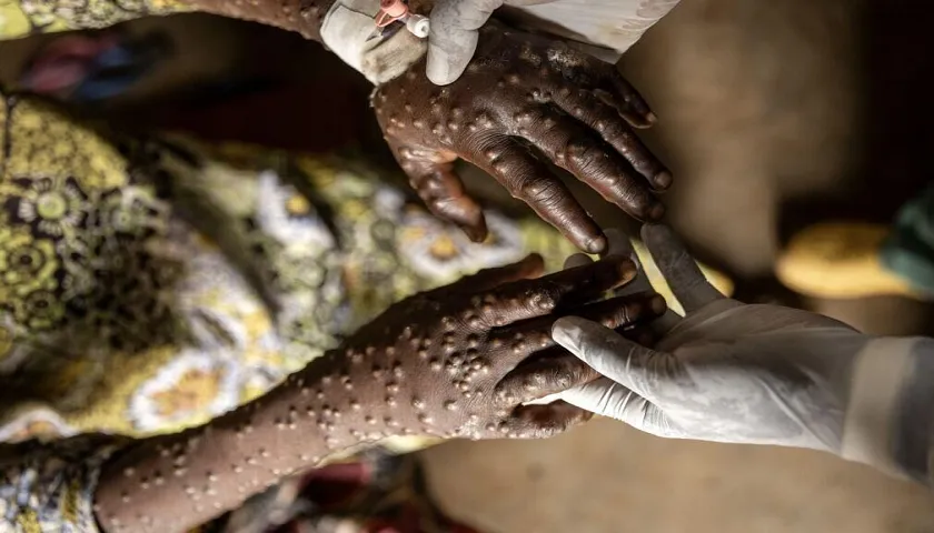 Alerta de Mpox no Uíge e Zaire