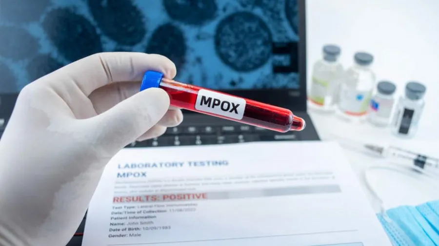 Registados 12 novos casos de Mpox em Angola e 18 altas médicas