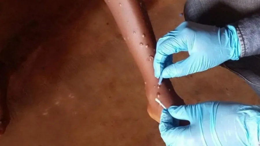 Mpox: dois casos confirmados em Cabinda