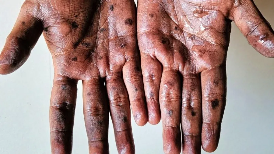 País regista quatro novos casos de Mpox nas últimas 24 horas