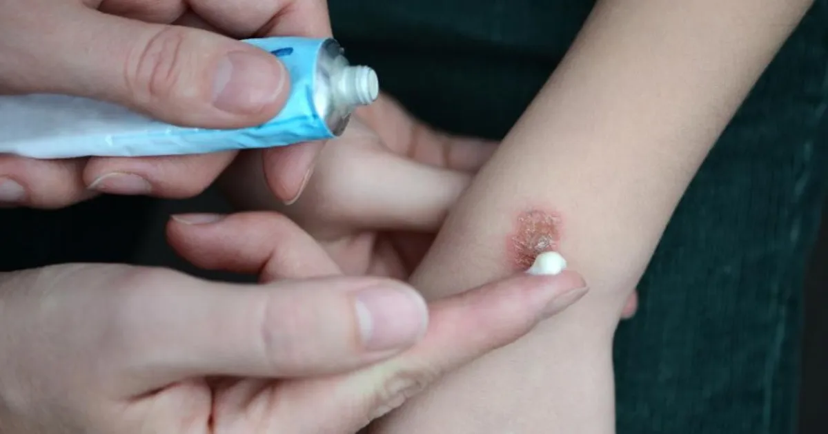 Cientistas criam creme capaz de reduzir cicatrizes em mais de 50 porcento
