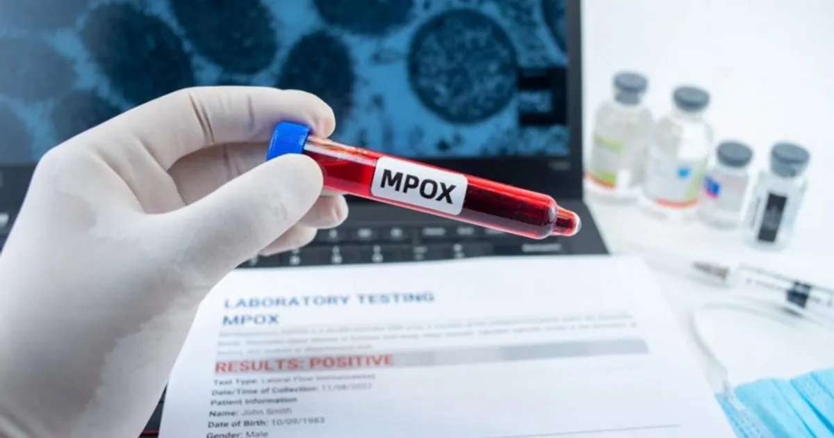 Autoridades da Namíbia declaram surto de mpox em Swakopmund