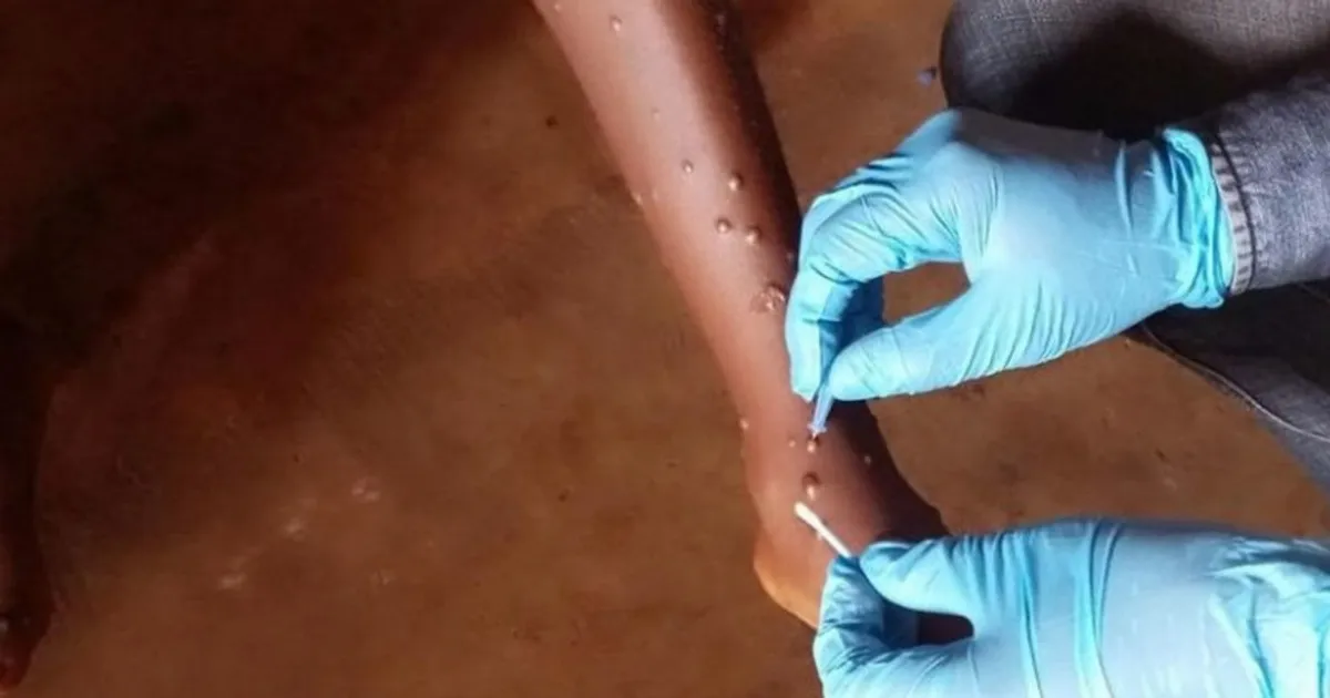 Sobe para 11 o número de distritos afectados pela mpox no Malawi
