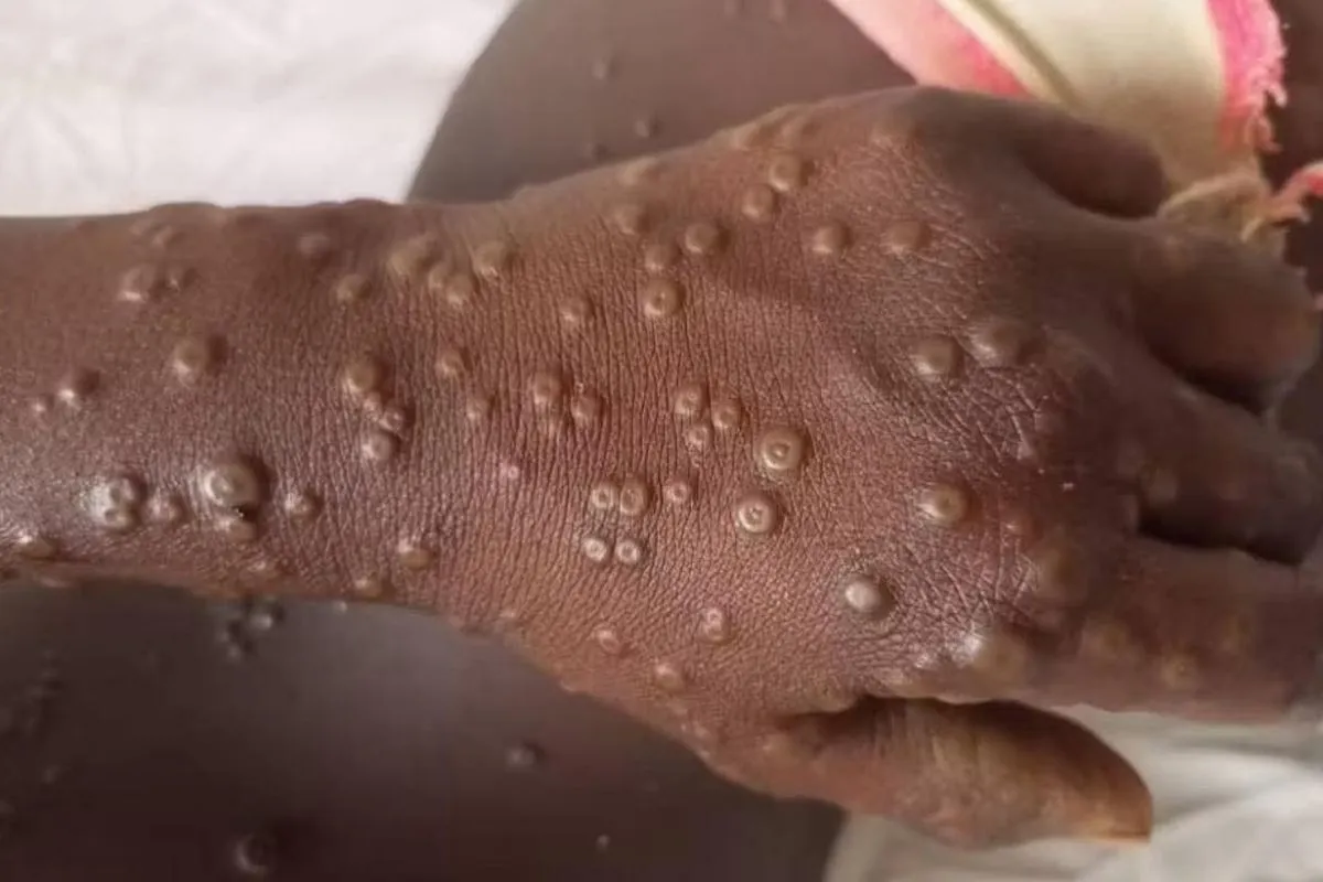 Angola regista 4 novos casos de Mpox em 24 horas e soma 87 casos activos