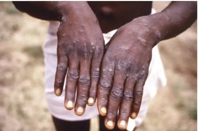 Cunene regista primeiro caso de Mpox