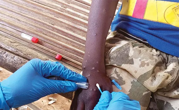 Cabinda vai receber mais 30 mil doses de vacinas contra Mbox