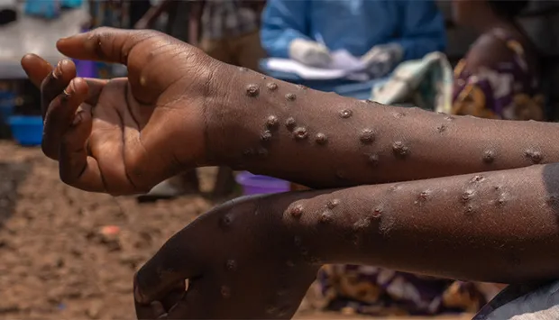 Angola regista oito novos casos de MPOX nas últimas 24 horas