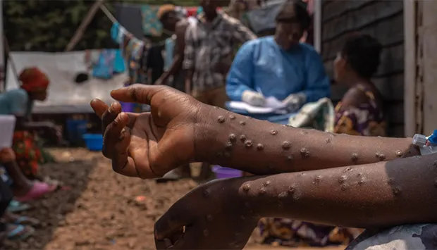 Angola regista dois novos casos de Mpox no Moxico