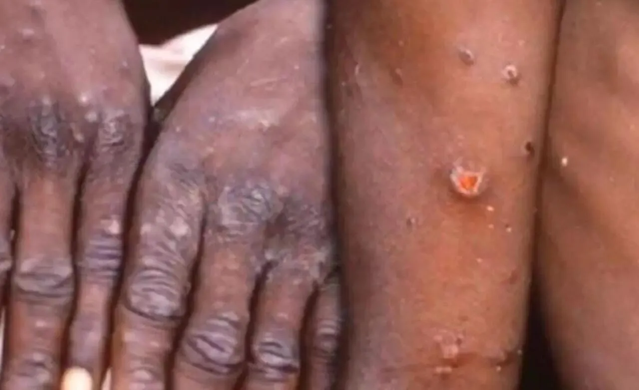Moxico regista dez casos de varíola de macaco importados de Cabinda e Moxico-Leste