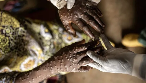 Mpox: Angola regista quatro novos casos e igual número de altas nas últimas 24 horas