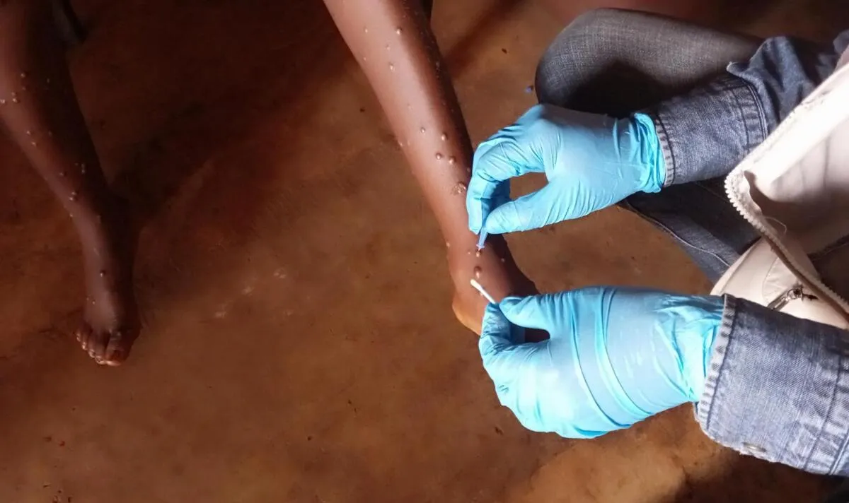 Angola regista 7 novos casos de mpox em 24 horas, com 102 casos activos e 9 altas médicas