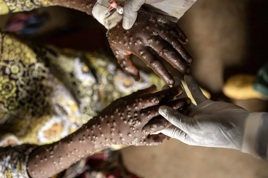 Sobe para 593 o número de casos de Mpox no País, com mais 15 infectados registados nas últimas 24 horas