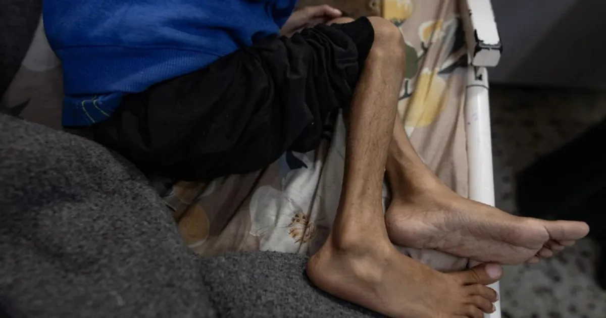Médio Oriente: Homem morre em Gaza por desnutrição e total de mortos por fome sobe para 67