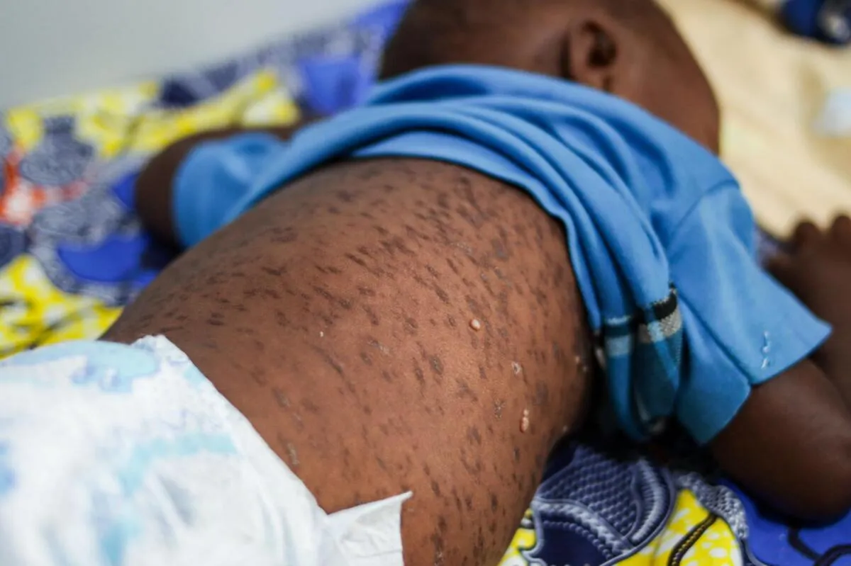 Sarampo causa 15 mortos em mais de 500 casos na província do Cubango