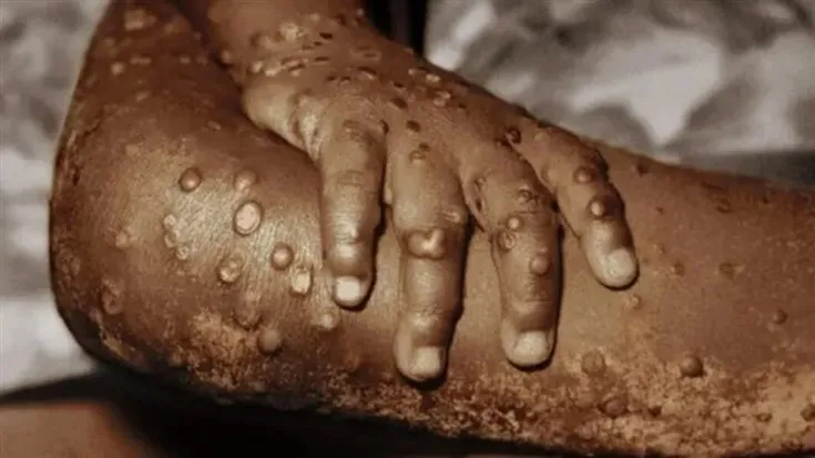 Número de casos de Mpox sobe para 596, depois de registados três novos infectados na Lunda-Sul