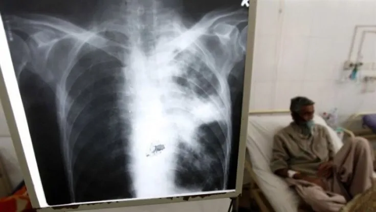 Taxa de mortalidade por tuberculose em Angola baixou para quase metade em 2025, mas doença continua a ser a terceira causa de morte no País - Governo