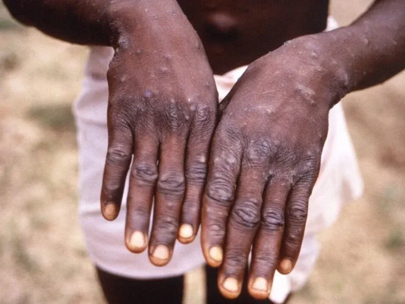 Mpox sobe para 596 casos em Angola após mais três infecções na Lunda-Sul