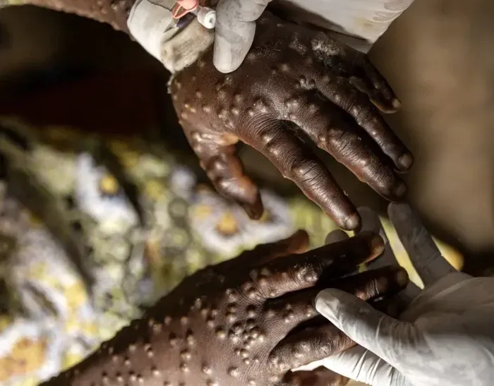 Angola contabiliza 92 casos activos de Mpox