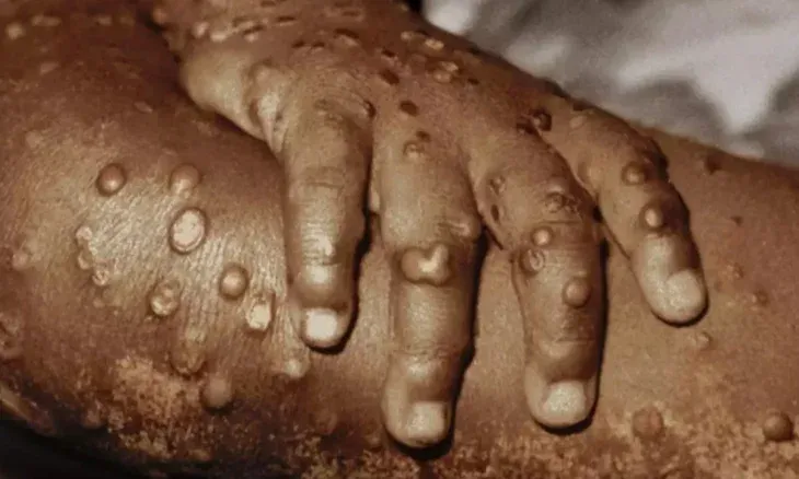 País regista 15 novos casos de Mpox nas últimas 24 horas