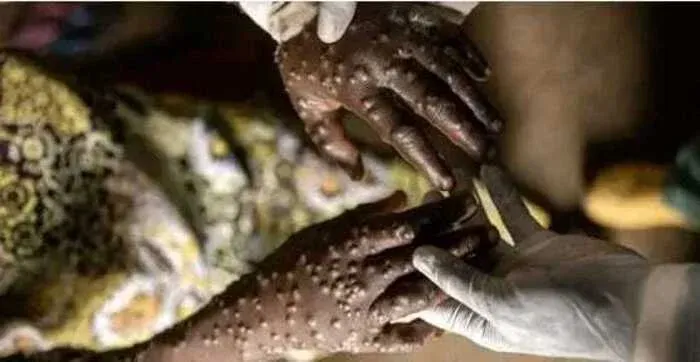 Angola regista mais de 400 casos de Mpox e duas mortes desde 2024