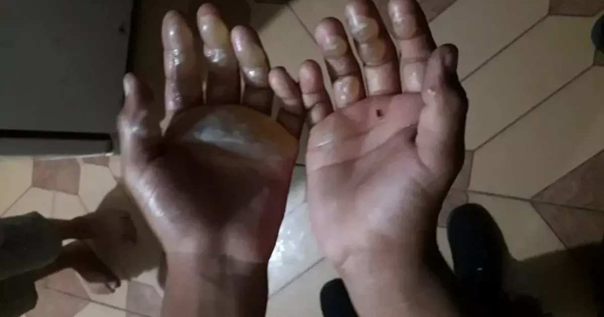 Mãe queima braços do filho de cinco anos por suposto roubo na panela da vizinha