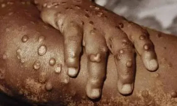 Cabinda regista primeiro caso de morte por Mpox