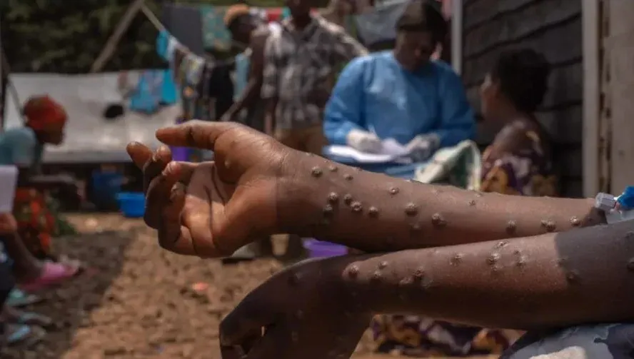 Cabinda concentra 200 dos 289 casos de Mpox registados em Angola