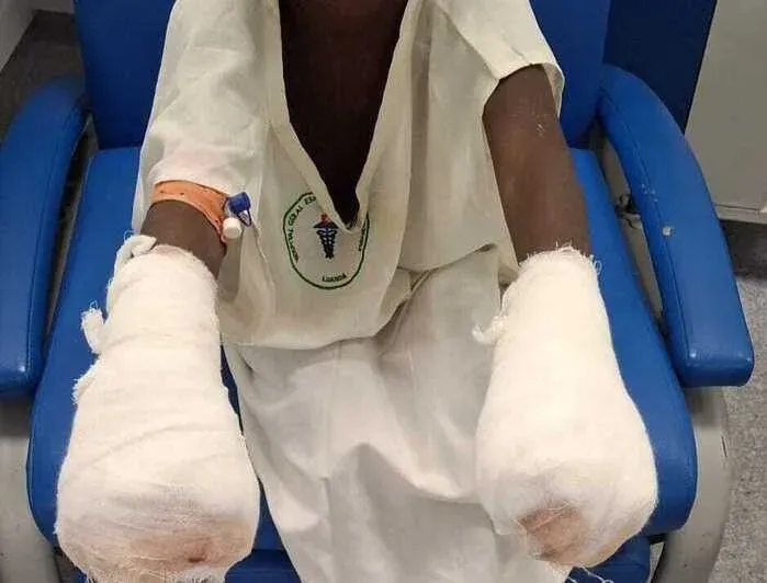 Pai queima mãos dos filhos por suposto furto de 100 kwanzas no Zango 3