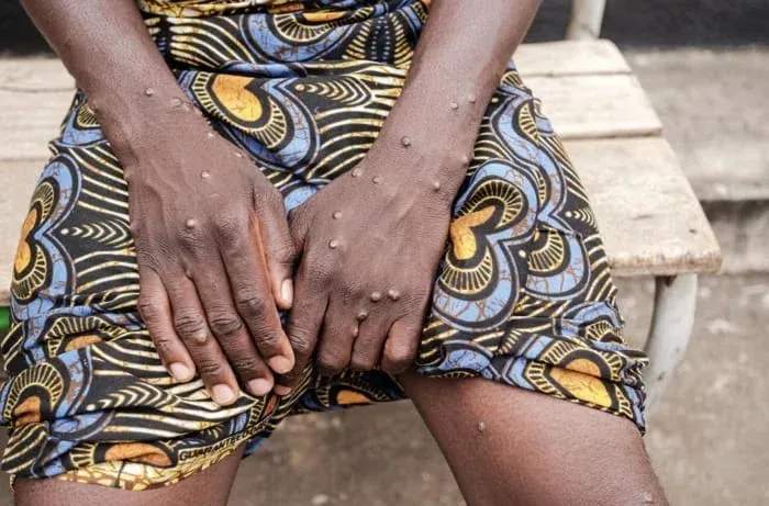 Angola contabiliza 100 casos activos de Mpox