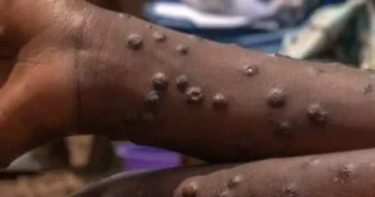 Casos confirmados de mpox em Moçambique provenientes do Malawi