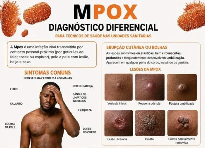 Angola regista 19 novos casos de Mpox nas últimas 24 horas