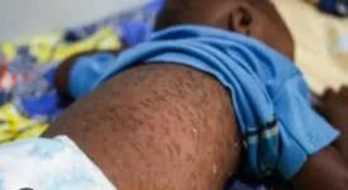 Cazombo regista mais de mil casos de sarampo e oito mortes
